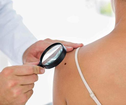 Breast-Cancer-Might-More-Moles